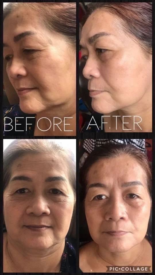 Before and after facial treatment